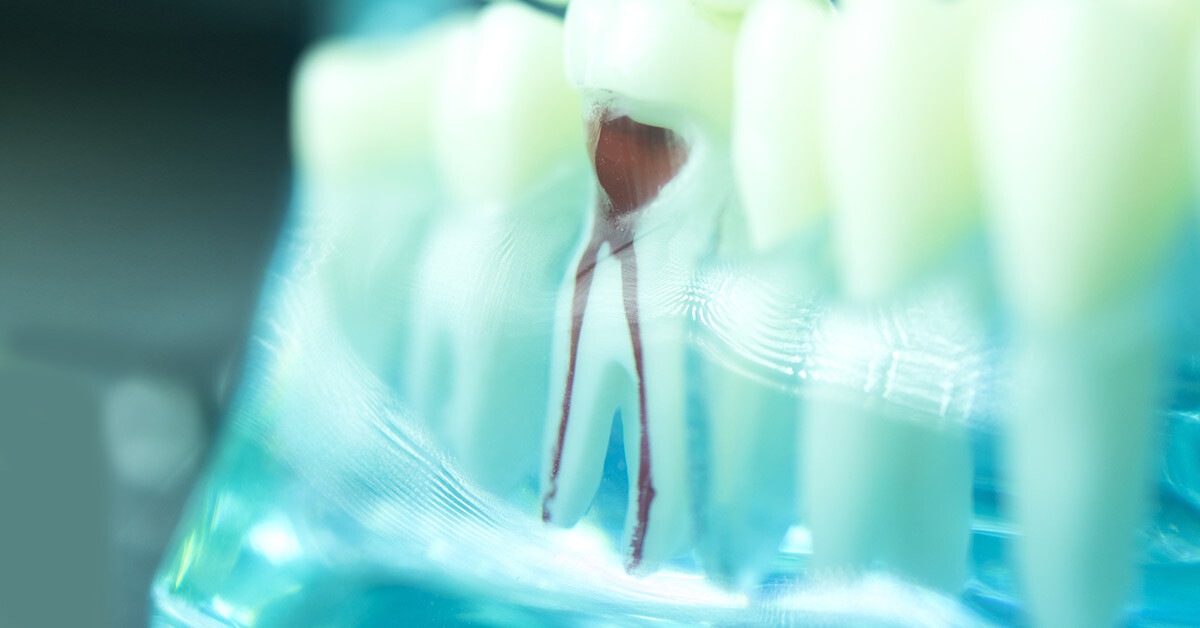 root canal in plano tx