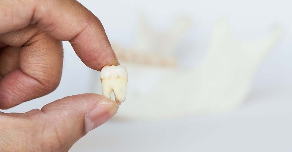 Foods you can eat after wisdom teeth are removed