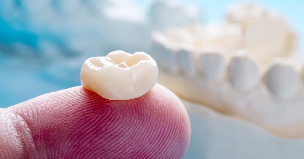 Is a Crown Falling Out a Dental Emergency?