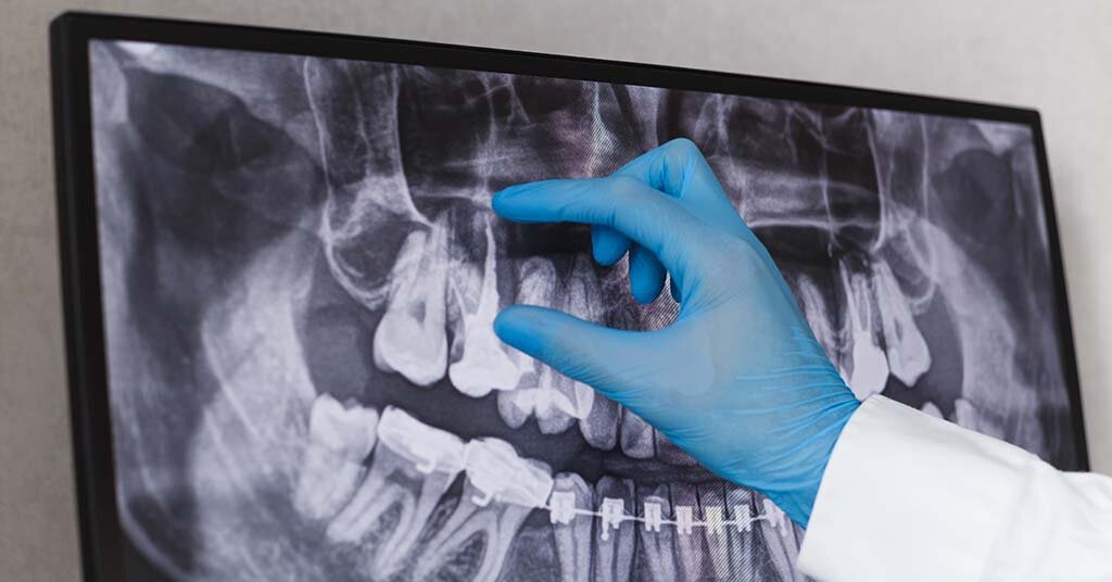 Are dental x-rays safe?