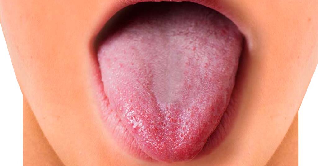 Why do I have painful tongue bumps?